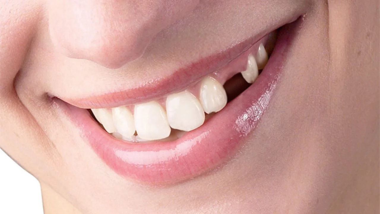 Mơ bị gãy một hay nhiều chiếc răng cũng là điềm báo về sức khỏe